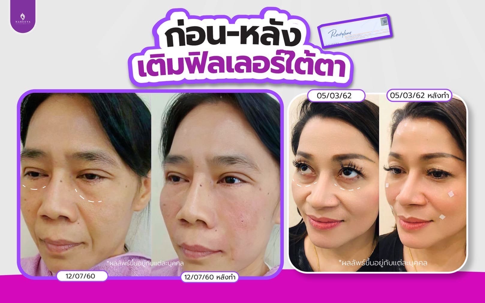 ฟิลเลอร์ใต้ตา (4)