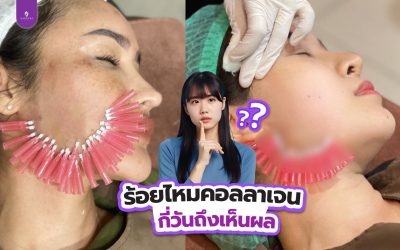 ร้อยไหมคอลลาเจนกี่วันเห็นผล??