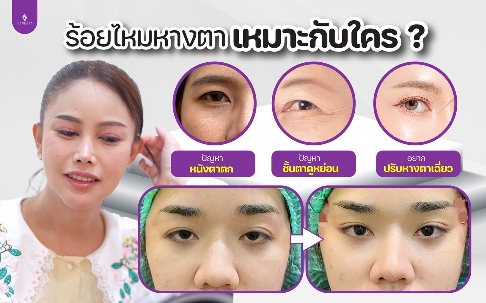 การร้อยไหม Foxy Eyes คือ (1)