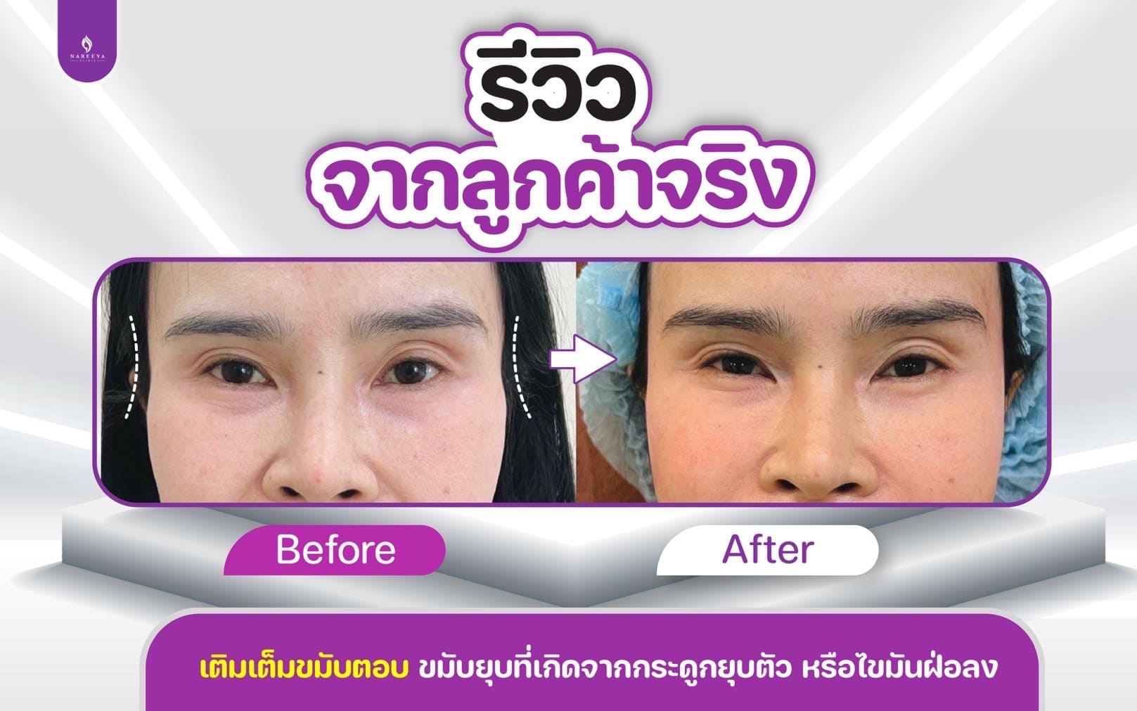 ฟิลเลอร์ขมับ (2)