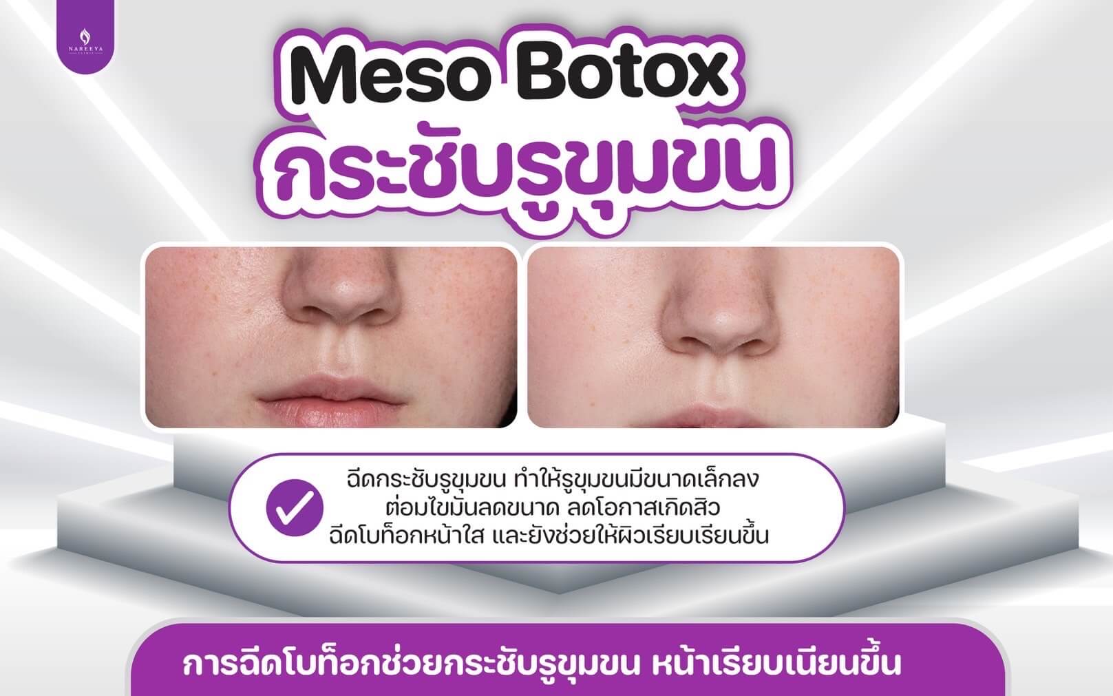 เมโส โบท็อกซ์ (3)
