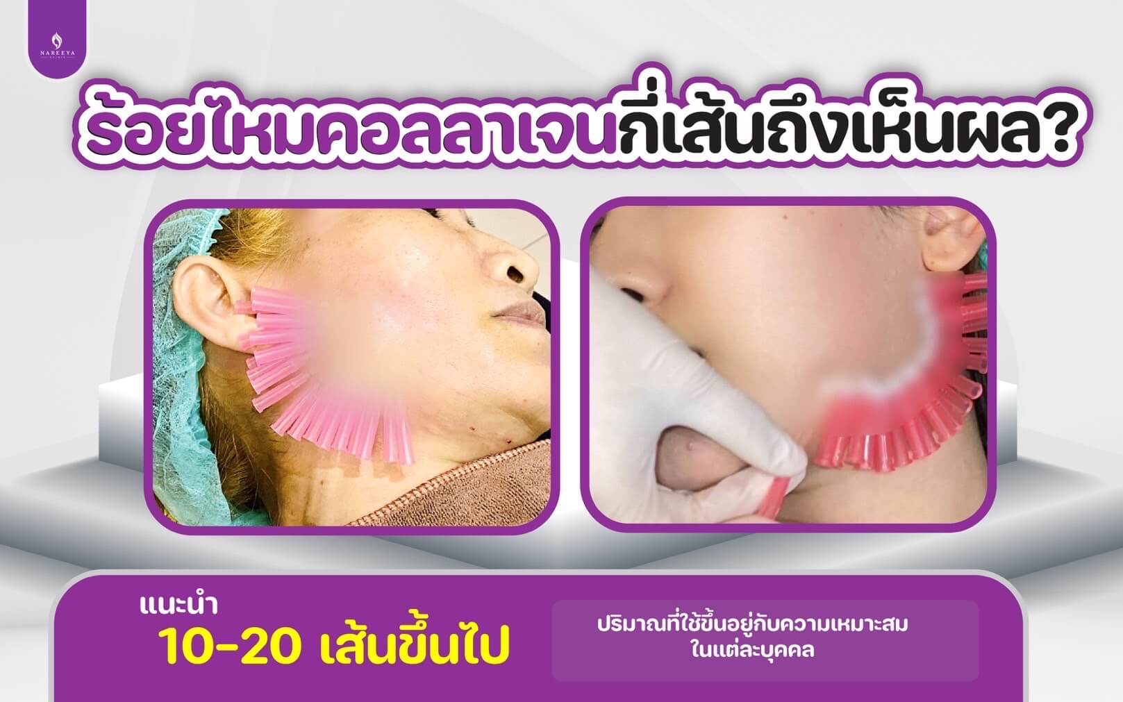 ไหมคอลลาเจน (3)