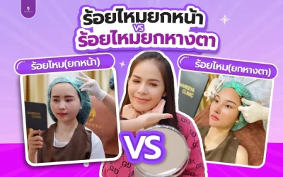 การร้อยไหมยกกระชับหน้า (Thread Lifting)